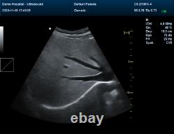 Color Doppler Vascular Ultrasound Scanner with 3.5mhz abdominal probe, Battery