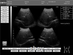 Digital Laptop Ultrasound Scanner Machine, 3.5mhz Abdomen Convex Probe USA CE FDA
